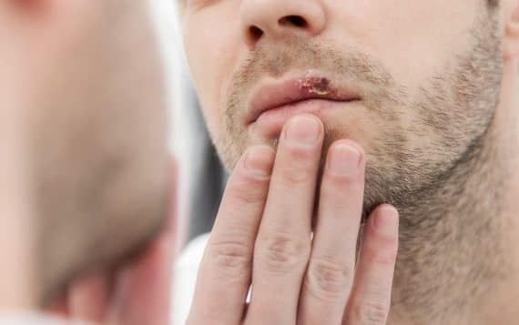 Herpes: cómo tratarlo