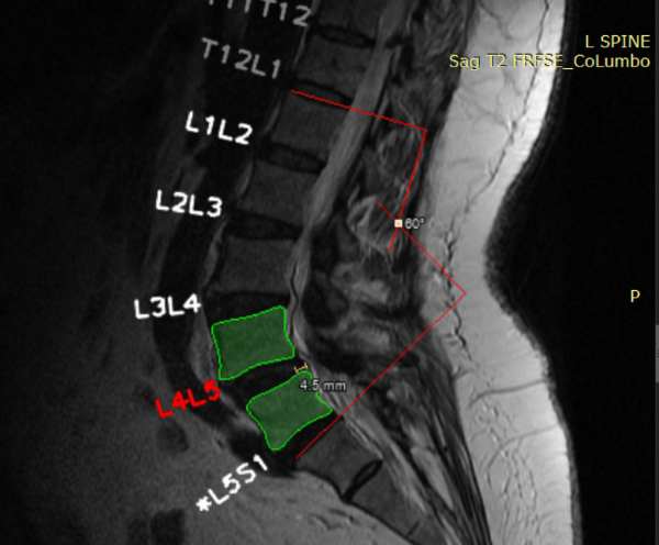 Unilabs se asocia con el proveedor de IA SmartSoft Healthcare para mejorar la lectura y generación de informes de resonancia magnética de columna lumbar en España